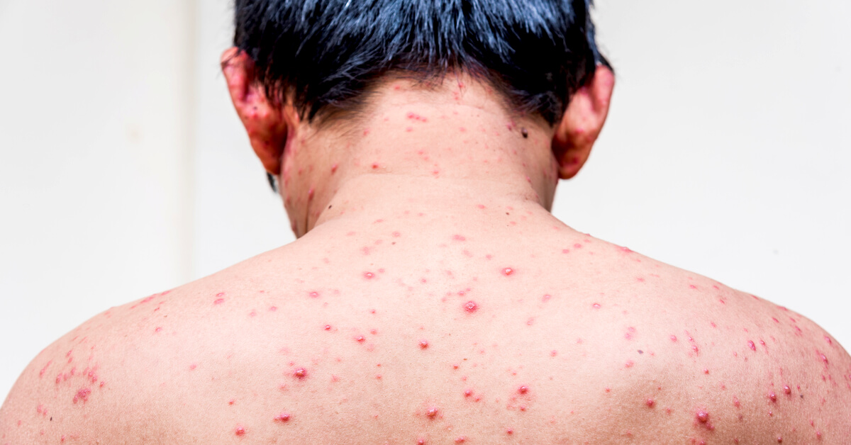 تعرف على أعراض الإيدز وطرق الوقاية منه