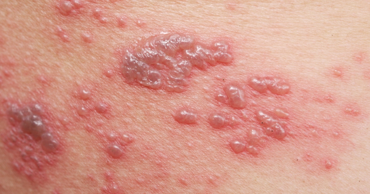 يعرف مرض الهربس النطاقي هو عبارة عن مرض جلدي فيروسي معدي حاد، يسبب التهاب أو طفح مؤلم على الجلد