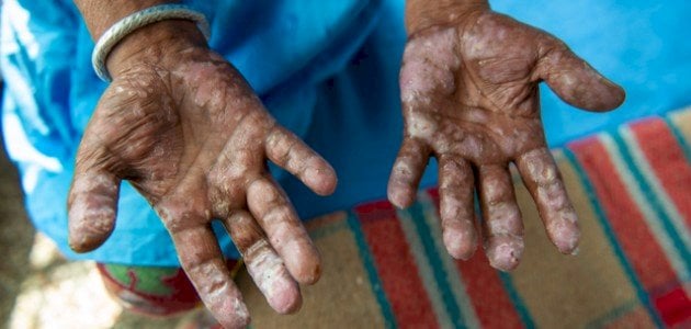 مرض الجذام اسبابه و اعراضه وعلاجه