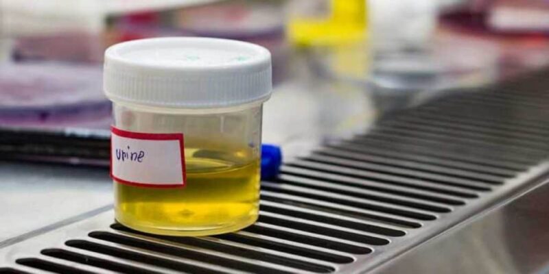 كيف اعرف اني حامل من لون البول